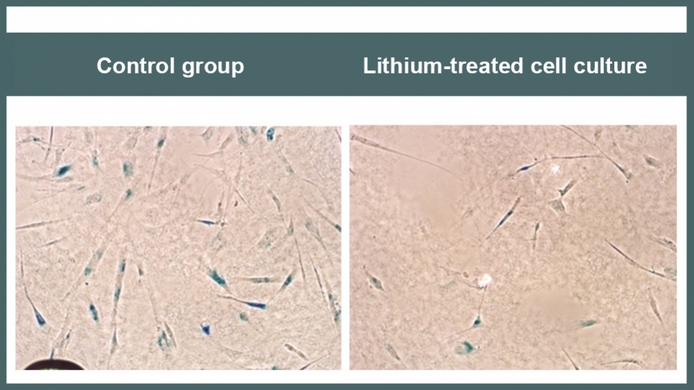 The benefits of lithium in older people with Alzheimer’s disease are starting to be understood