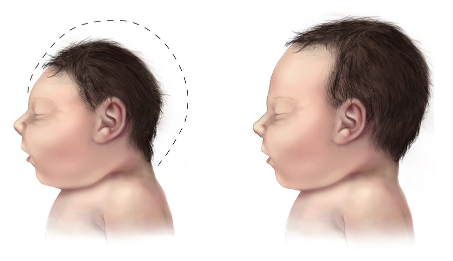 Researchers discover how infection by Zika virus during pregnancy can affect the fetal brain