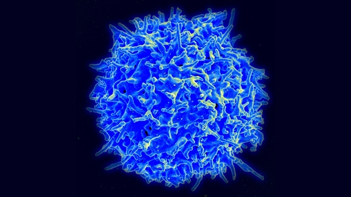 Study suggests SARS-CoV-2 can infect and kill lymphocytes