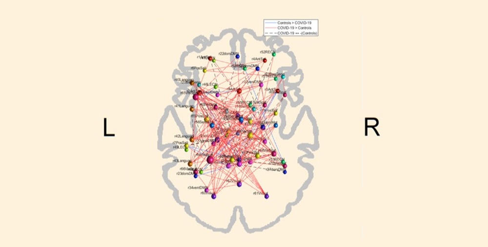 COVID-19 pode alterar o padrão de conectividade funcional do cérebro, aponta estudo
