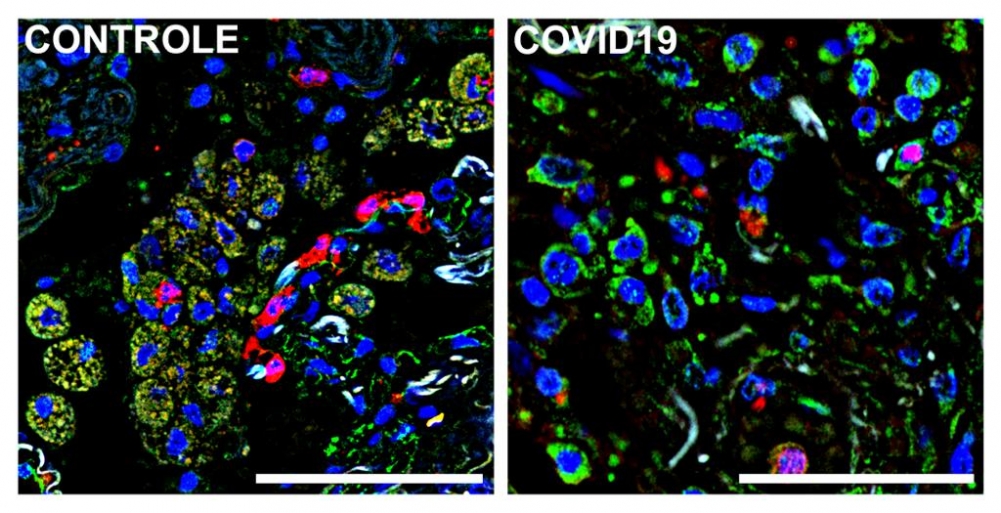 SARS-CoV-2 inibe remoção de células mortas pelo sistema imune e isso favorece o dano pulmonar, diz estudo