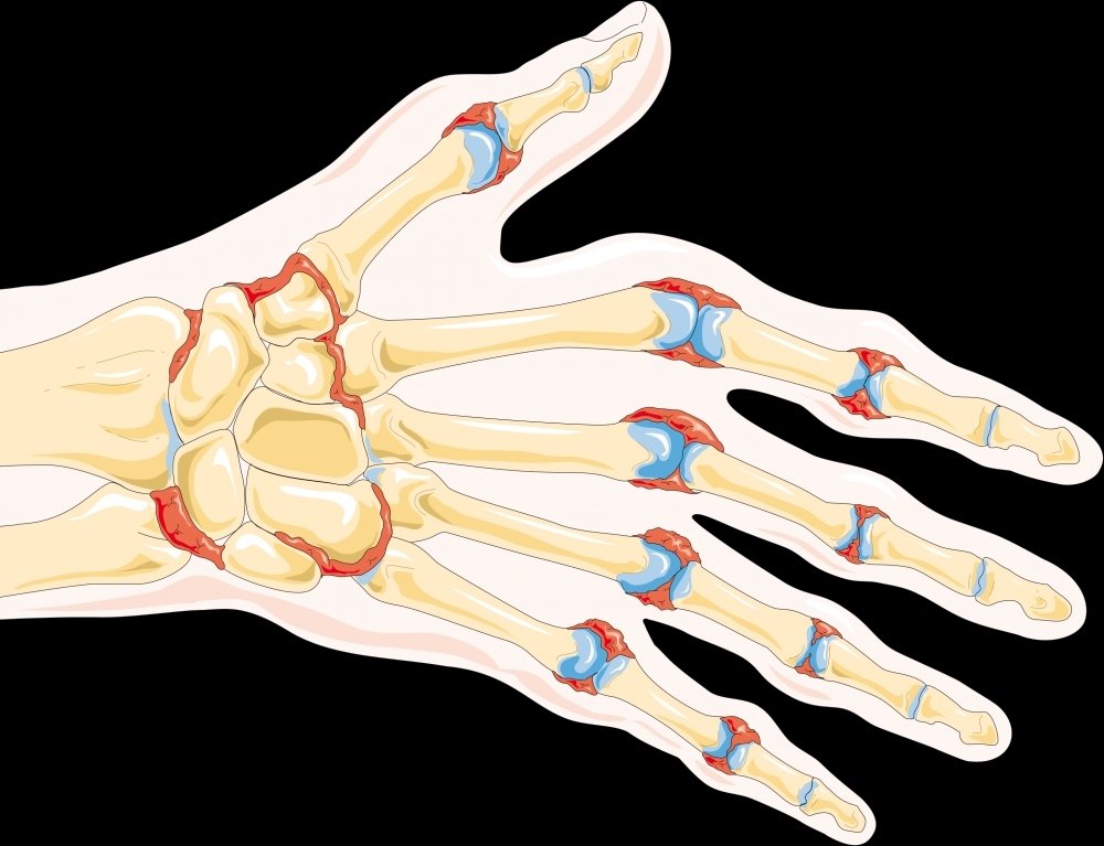 Researchers discover inflammatory mechanism responsible for bone erosion in rheumatoid arthritis 