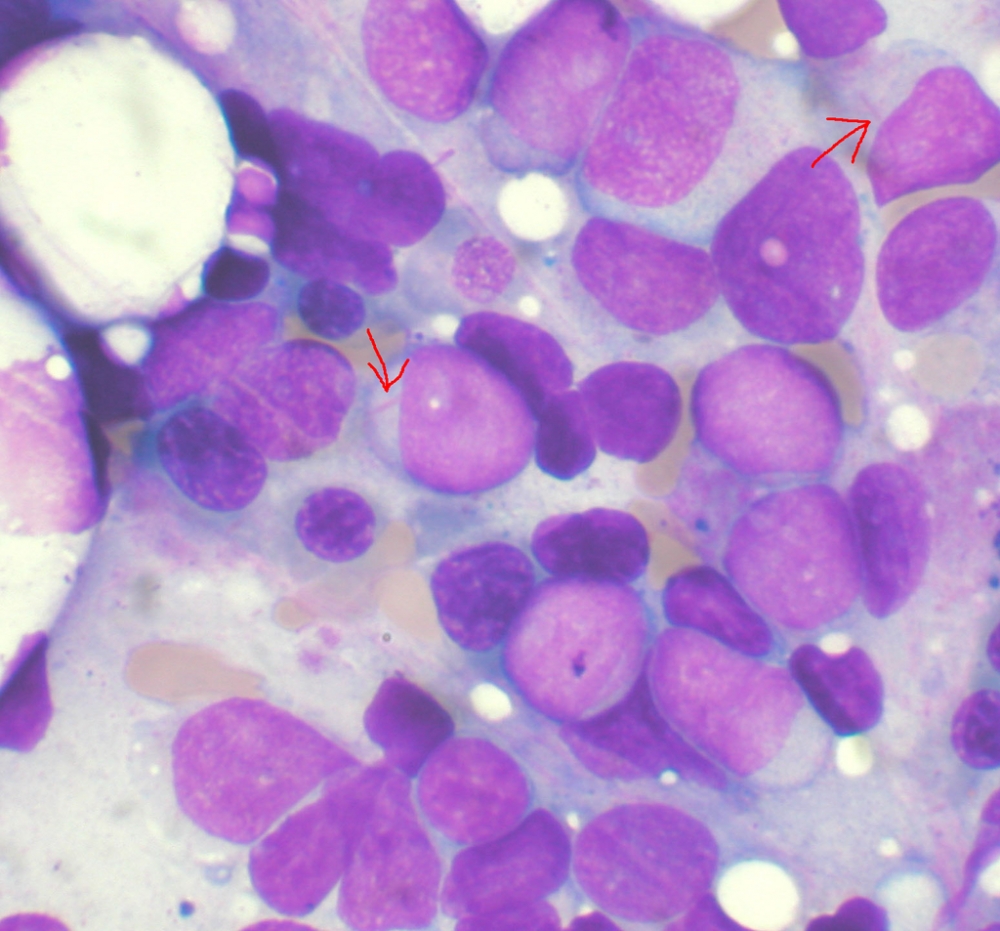 Pesquisadores identificam proteína associada ao agravamento da leucemia mieloide aguda
