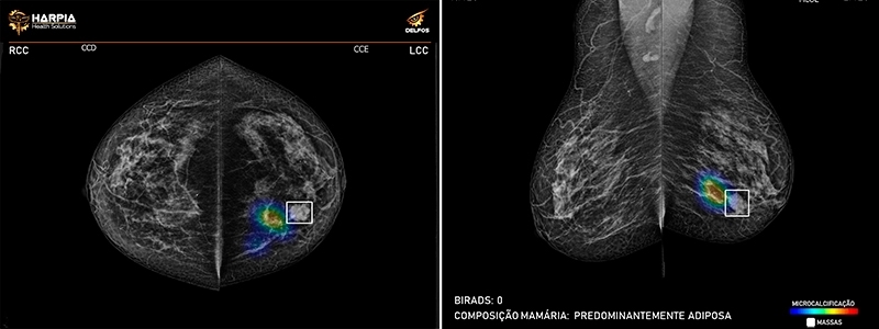 Computational solution automatically identifies alterations in mammograms