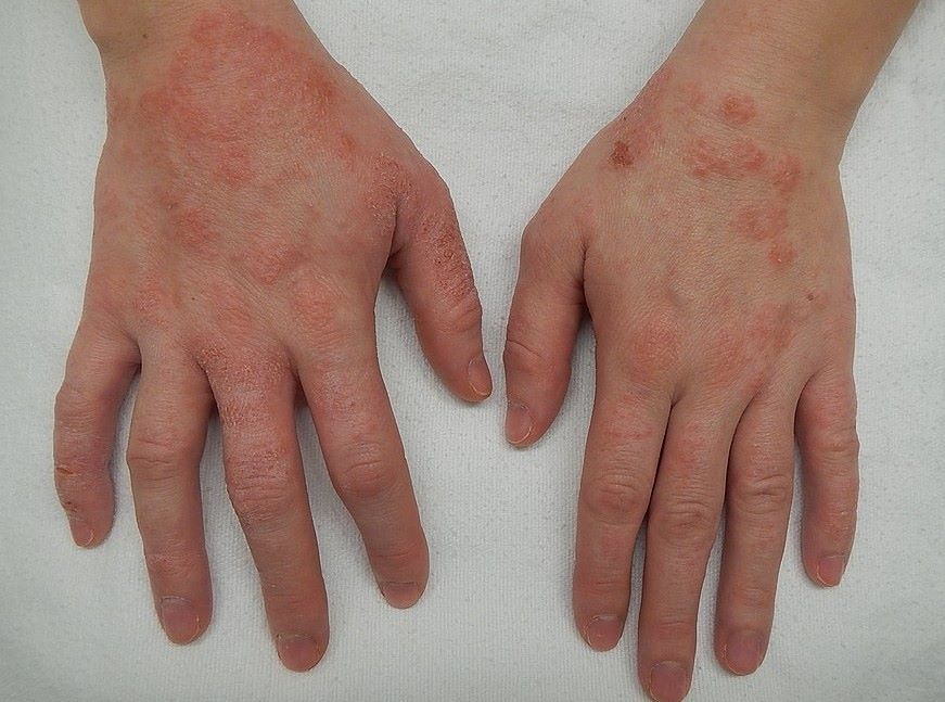 Conexão intestino-pele é fator central em casos de dermatite atópica, mostra revisão de estudos