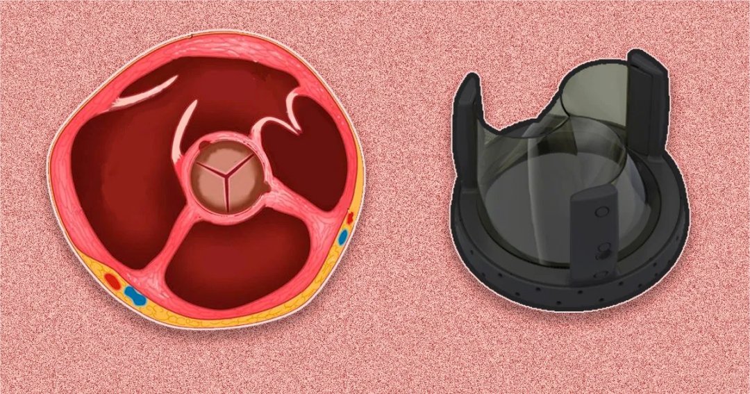 Brazilian scientists design innovative heart valve