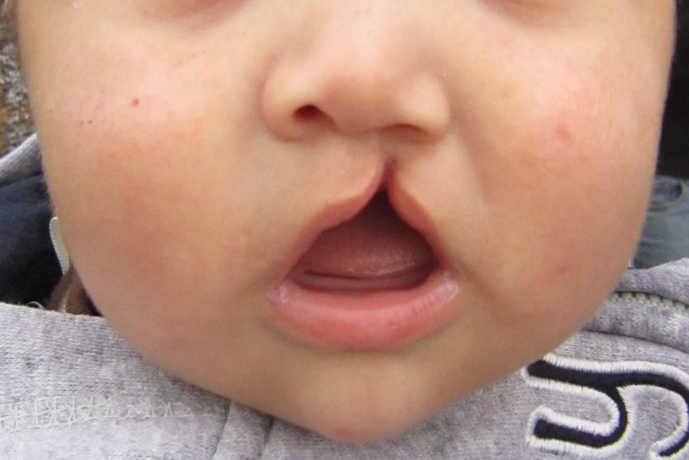 Inflammation during pregnancy can cause cleft lip in individuals with a genetic predisposition
