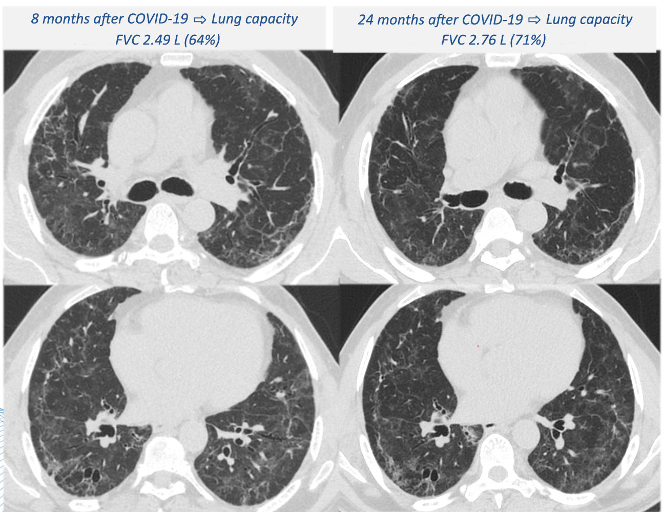 Lung complications can worsen two years after hospitalization for severe COVID-19
