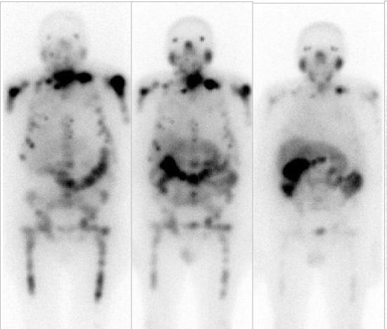 Radiopharmaceutical synthesized in Brazil improves quality of life for prostate cancer patients