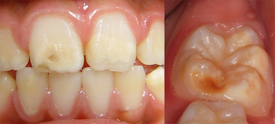 Fatores ambientais, genéticos e doenças na infância estão associados a dentes fracos, sensíveis e opacos em crianças