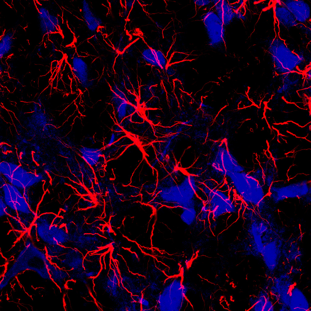 Insulin resistance in the brain may be one of the factors linking Alzheimer’s disease and epilepsy