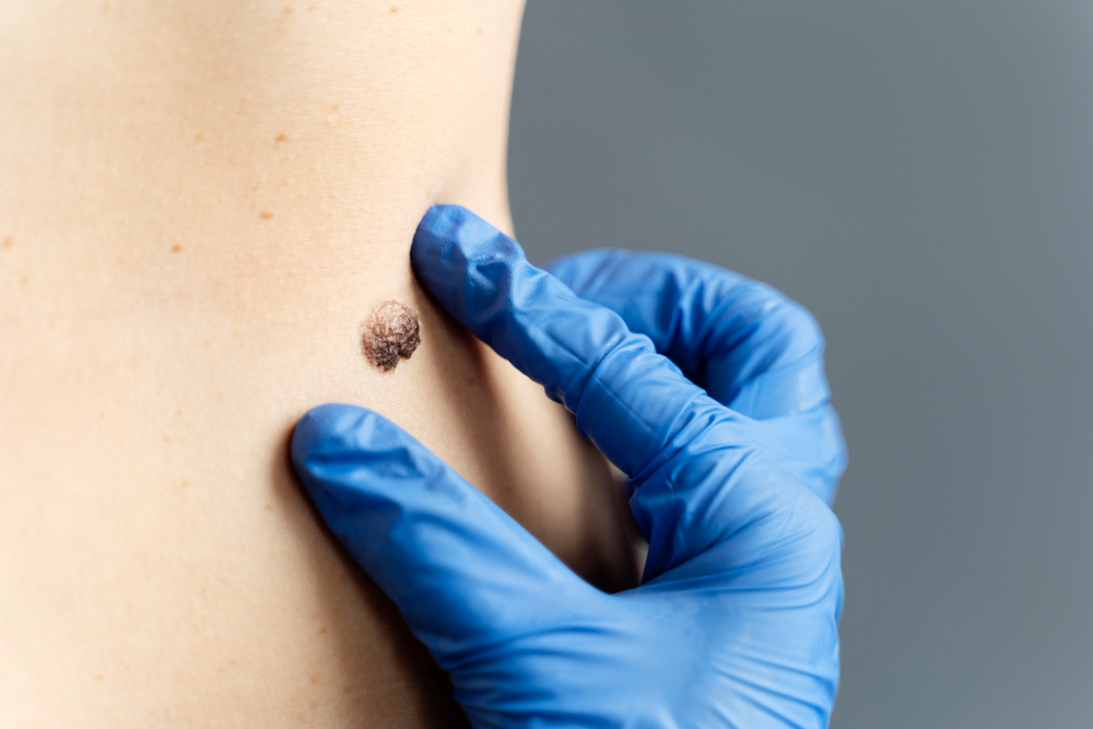 Study identifies genes that can predict response to immunotherapy in melanoma patients