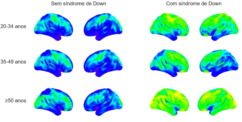 Neuroinflamação precoce em pessoas com síndrome de Down explica alta prevalência de Alzheimer nessa população