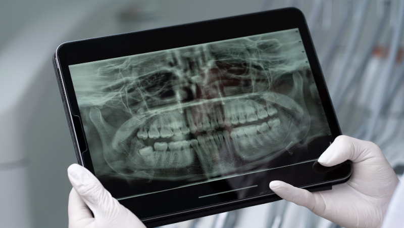 Saliva artificial ajuda a proteger os dentes de pacientes com câncer de cabeça e pescoço