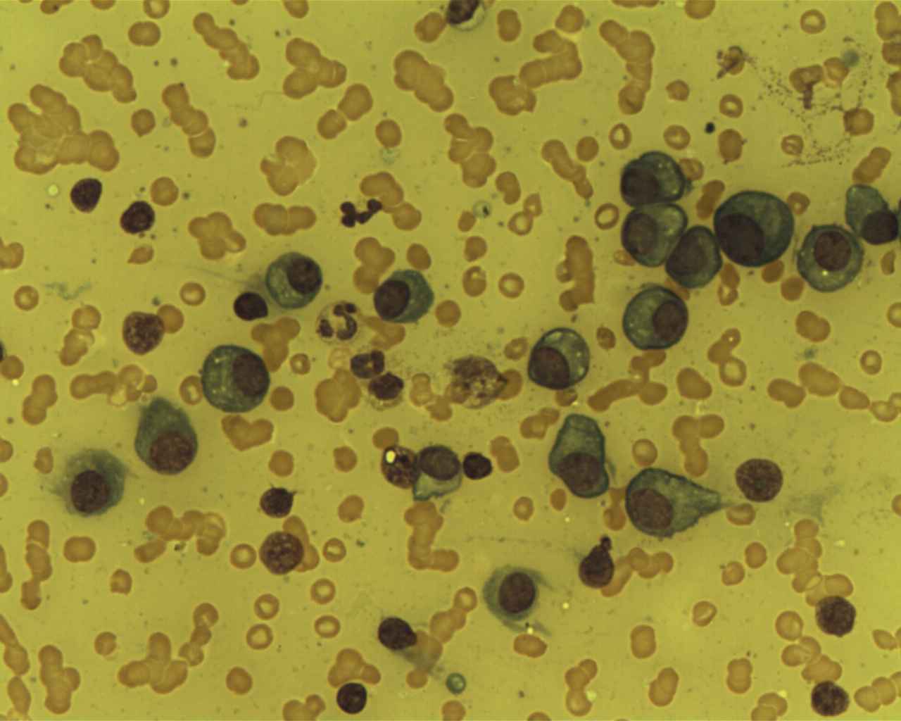 Project seeks to cut treatment costs for type of blood cancer in half