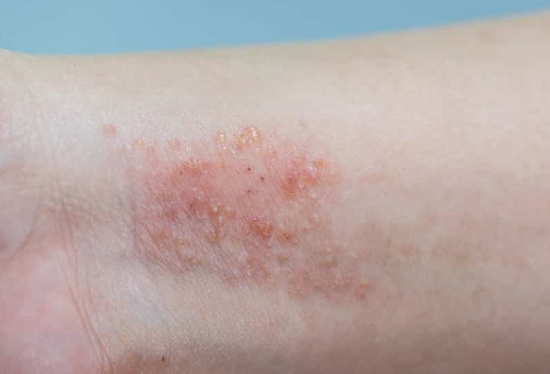 Researchers at a translational science center develop new drug for skin diseases