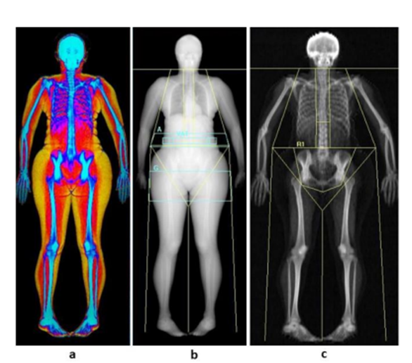 Abdominal fat is linked to a higher risk of urinary incontinence in women