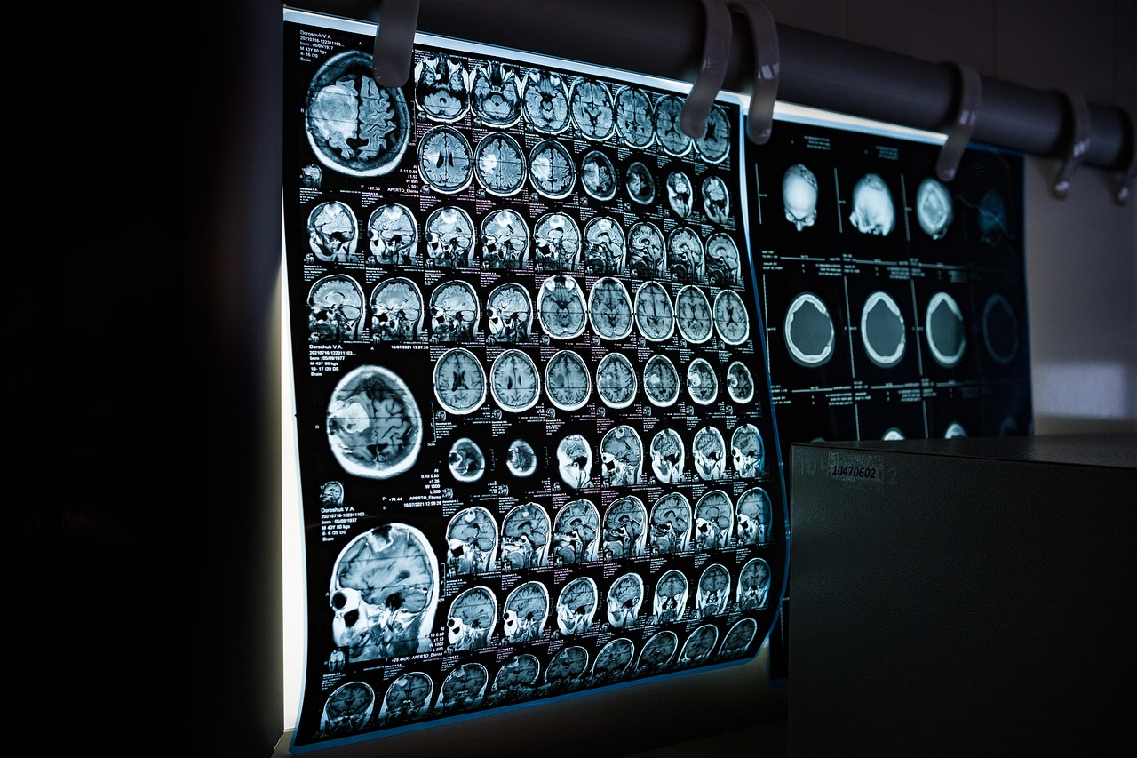 La duración de la depresión puede modular cómo la gravedad de la enfermedad altera el cerebro