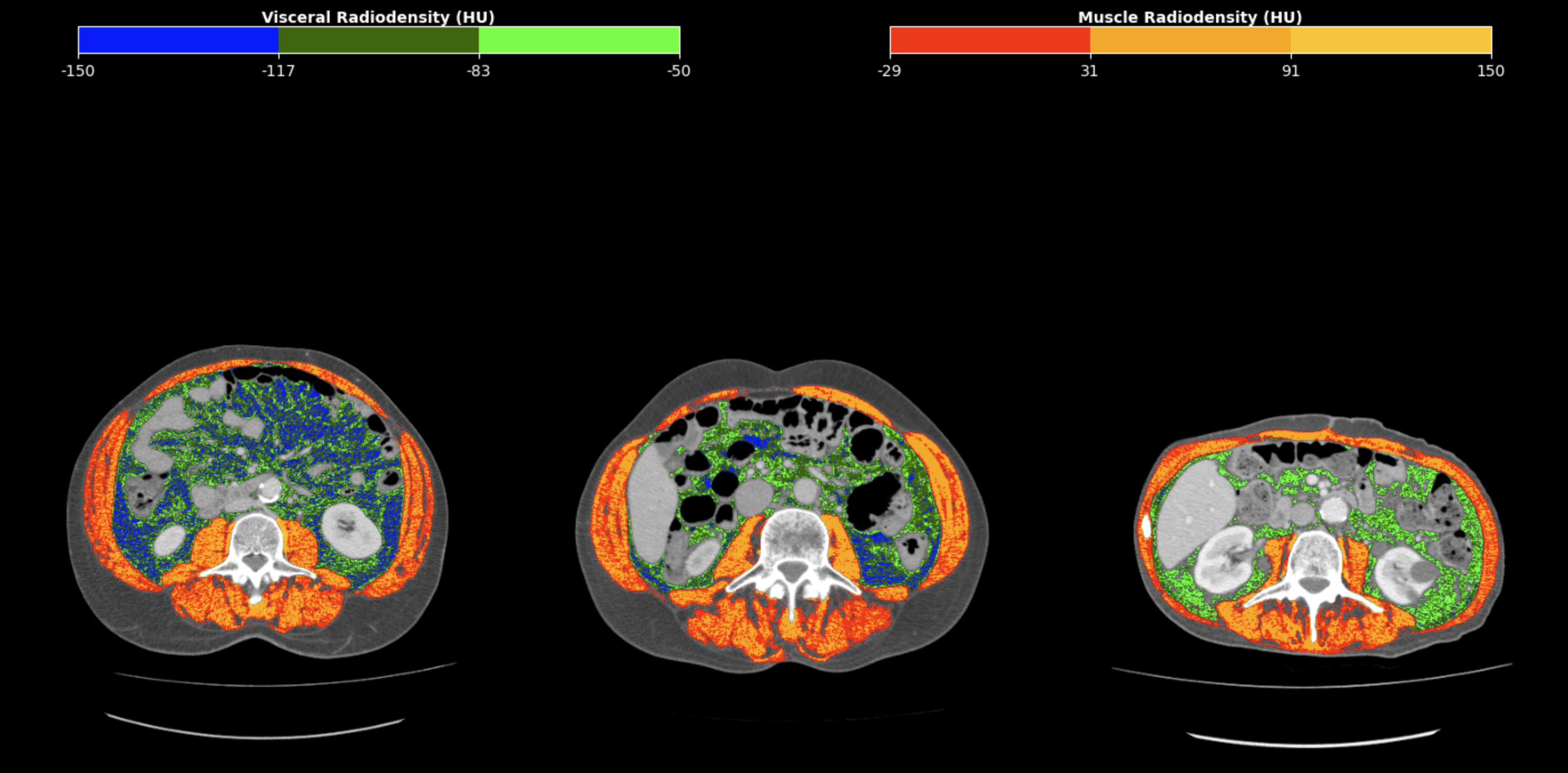 Unprecedented marker uses tomography to refine gastric cancer prognosis