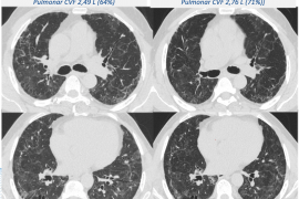 Sequela pulmonar pode piorar dois anos após a internação por COVID-19 grave