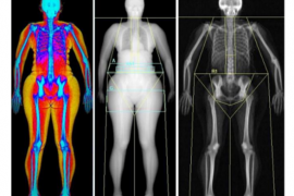 Abdominal fat is linked to a higher risk of urinary incontinence in women