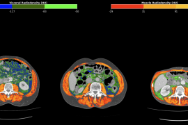 Unprecedented marker uses tomography to refine gastric cancer prognosis