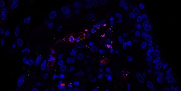 Forma grave da COVID-19 pode ter dois perfis: inflamação pulmonar exacerbada ou alta replicação viral