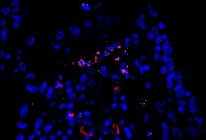 Severe COVID-19 can involve either exacerbated lung inflammation or high viral replication