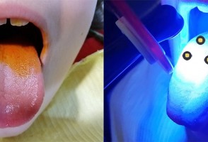 Photodynamic therapy with annatto colorant found to be effective against bad breath