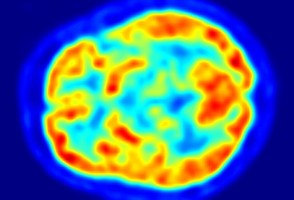 Un estudio global identifica marcadores para los cinco estadios clínicos de la enfermedad de Parkinson