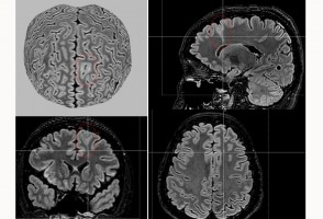 Ferramenta de IA detecta anormalidades cerebrais invisíveis em pessoas com epilepsia grave