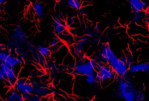Insulin resistance in the brain may be one of the factors linking Alzheimer’s disease and epilepsy