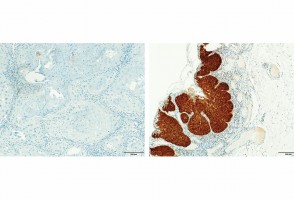 Bactéria comum na boca pode ajudar a prever evolução do câncer de cabeça e pescoço, aponta estudo