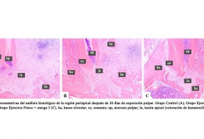 Combinación de ejercicio físico y omega 3 reduce la gravedad de infección en la raíz del diente