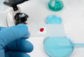 Estudo identifica proteínas envolvidas na eficácia de imunoterapia usada contra câncer no sangue