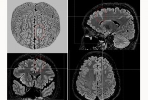 AI tool detects invisible brain abnormalities in people with severe epilepsy