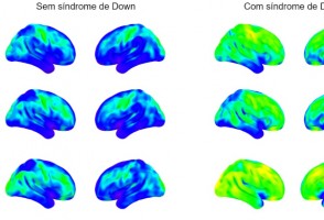 Neuroinflamação precoce em pessoas com síndrome de Down explica alta prevalência de Alzheimer nessa população