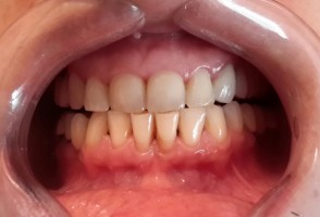 La saliva artificial con proteína de la caña de azúcar ayuda a proteger los dientes de pacientes con cáncer de cabeza y cuello