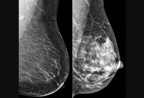 Brazilian research reveals how some types of breast cancer ‘evade’ treatment