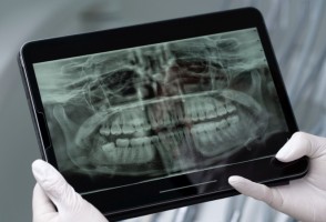 Saliva artificial ajuda a proteger os dentes de pacientes com câncer de cabeça e pescoço