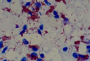 Exame de sangue associado a inteligência artificial abre caminho para diagnóstico precoce da hanseníase