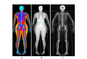 Gordura abdominal está ligada a maior risco de perda urinária em mulheres