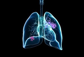 Biomarcadores no sangue ajudam a prever eficácia de imunoterapia contra câncer de pulmão