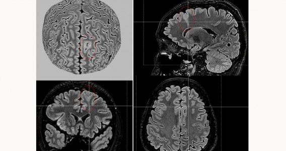 Ferramenta de IA detecta anormalidades cerebrais invisíveis em pessoas com epilepsia grave