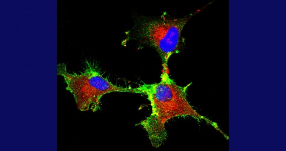 Study identifies key protein in progression of glioblastoma, a type of brain tumor