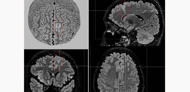 AI tool detects invisible brain abnormalities in people with severe ...