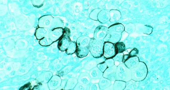 Estudio revela proteína vinculada al avance del cáncer de páncreas a lo largo de los nervios