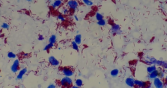 Exame de sangue associado a inteligência artificial abre caminho para diagnóstico precoce da hanseníase