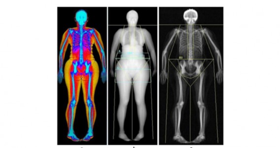 Gordura abdominal está ligada a maior risco de perda urinária em mulheres