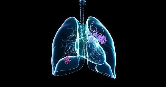 Biomarcadores no sangue ajudam a prever eficácia de imunoterapia contra câncer de pulmão